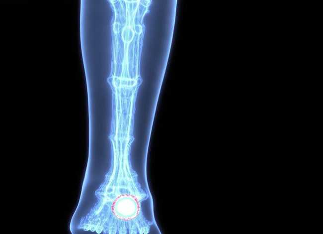 儿童胫骨囊肿的x片、儿童胫骨骨囊肿