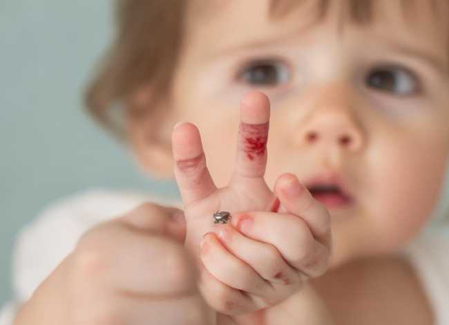 儿童被螺丝钉划伤；被小螺丝钉划了小伤口