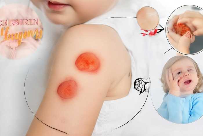 儿童痒疹图片 儿童痒疹图片及症状 儿童痒疹图片 儿童痒疹图片及症状