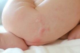 儿童尿布疹用什么药效果最好、儿童尿布疹用什么药效果最好的